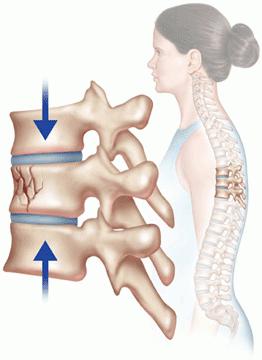 Årsaker, symptomer og behandling av kompresjonsbrudd i ryggraden